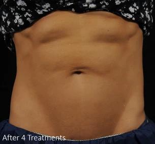 Accufit abdominal muscle toning treatment