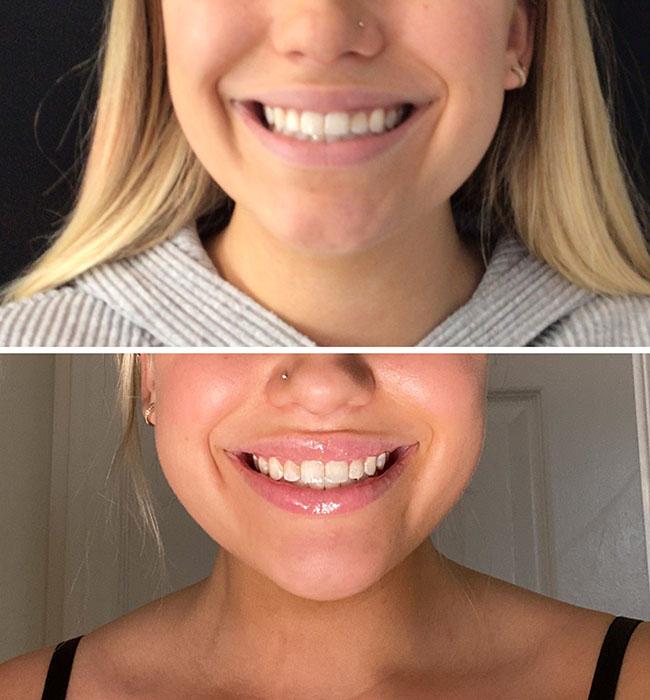 Before and after: Restylane Kysse
