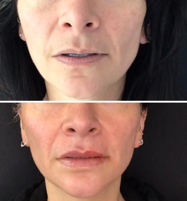Before and after: Restylane Kysse