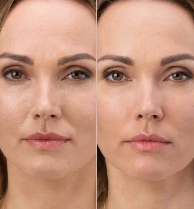 Before and after: RHA Filler