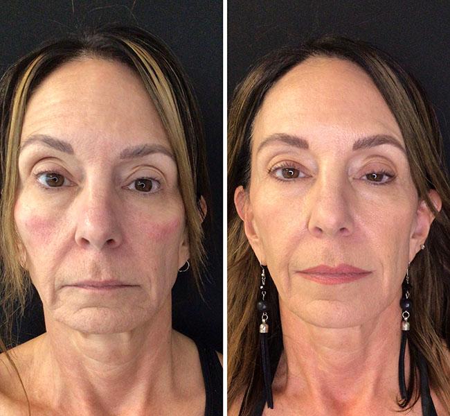 Juvederm full face filler