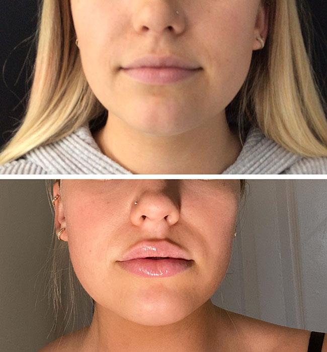Lips filler before and after
