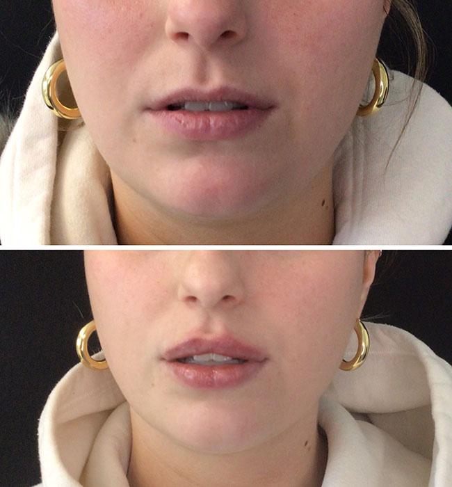 Lips filler before and after