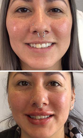Lips filler before and after
