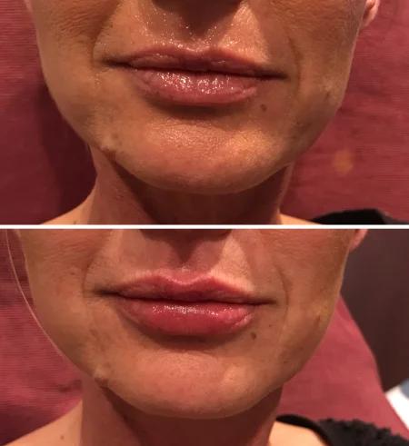 Lips filler before and after
