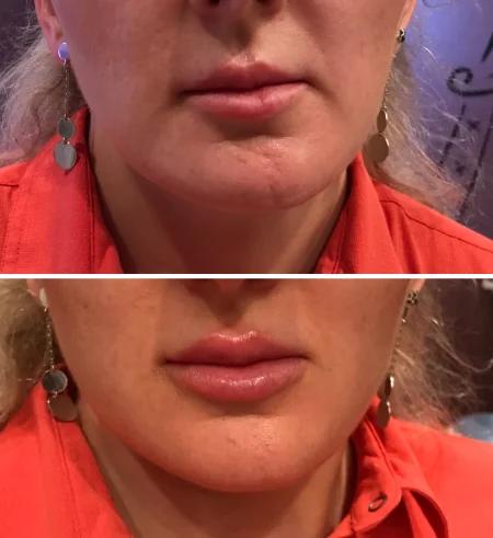 Lips filler before and after