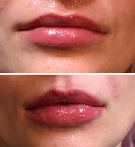 Lips filler before and after