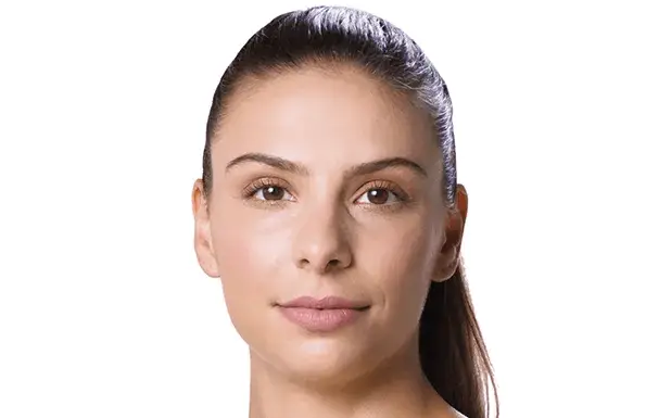 Juvederm Ashley (after)