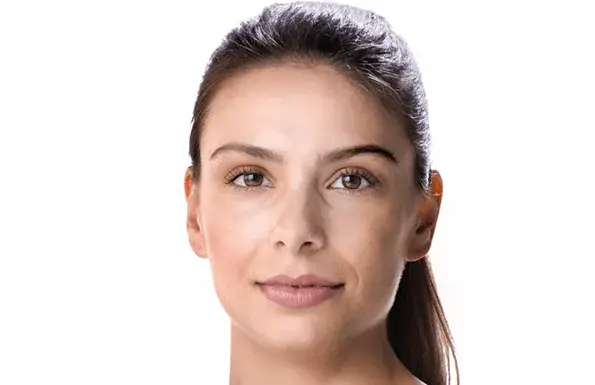 Juvederm Ashley (before)