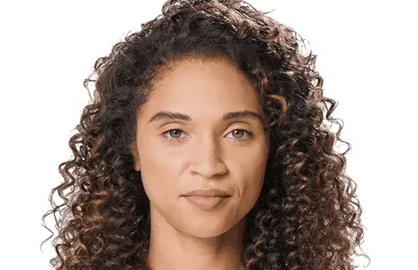 Juvederm Natasha (after)