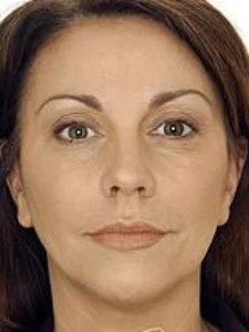 Mid cheek filler (before)