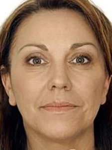 Mid cheek filler (after)