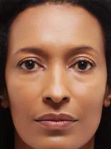 Mid cheek and lips filler 1 (before)