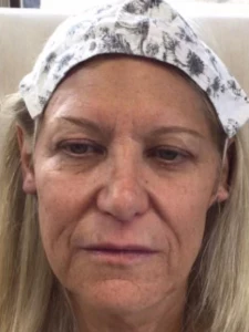 Mid cheek and lips combo (after)