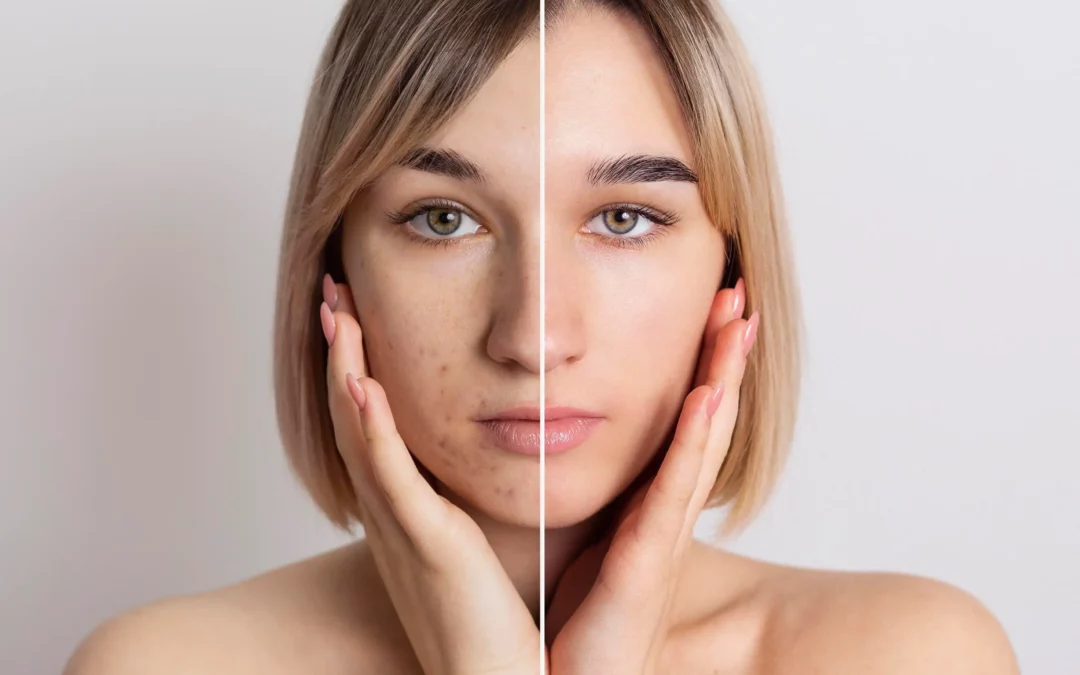 How Medical Spa Acne Treatments Can Transform Your Complexion